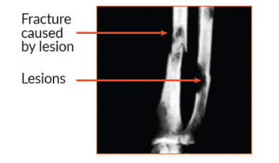 X-ray showing a fracture caused by a lesion.