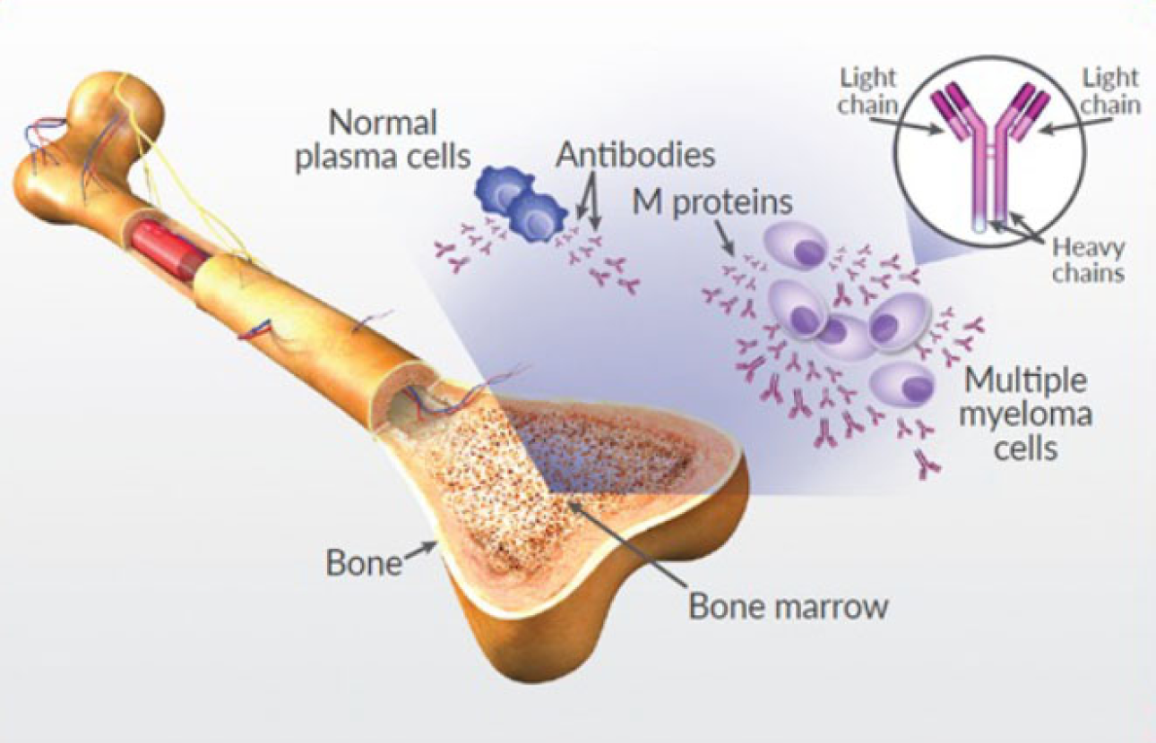 Diagram of bone structure, plasma cells, and multiple myeloma cells.
