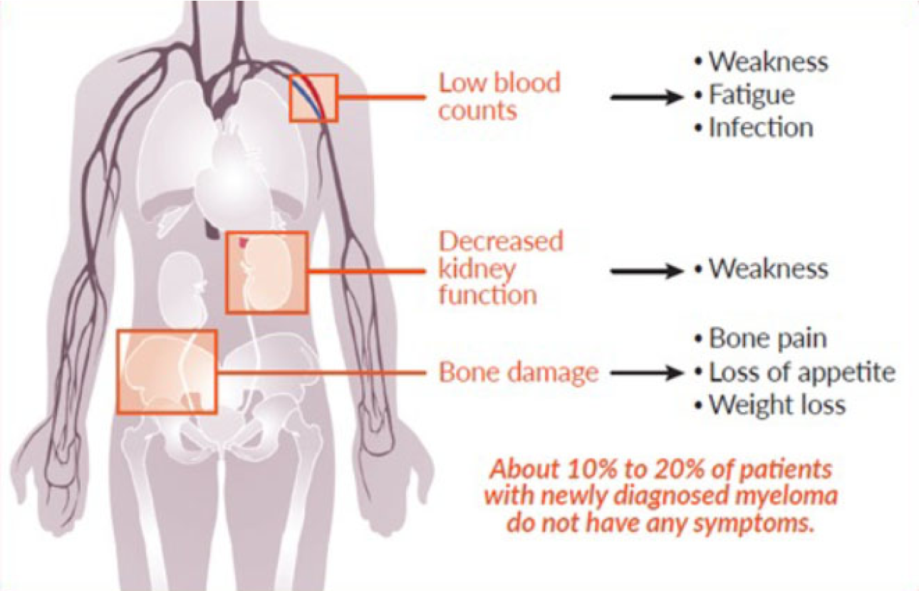 Illustration of body showing where common myeloma symptoms are located.